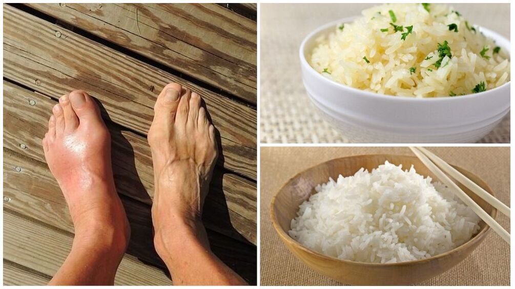 За пациенти со гихт се препорачува диета базирана на ориз. 